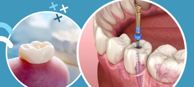 Do I Need A Root Canal