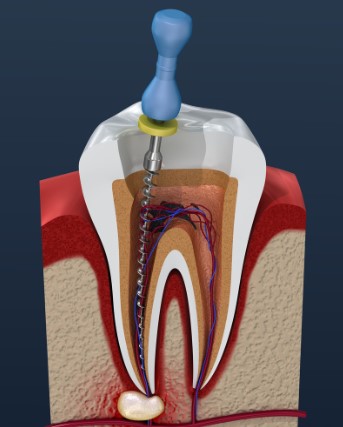 Do I Need A Root Canal, root canal necessity, should I get a root canal, determining root canal requirement, evaluating root canal need, root canal assessment, analyzing root canal necessity, root canal indication, root canal determination, necessity of root canal treatment, root canal necessity evaluation, root canal examination, root canal recommendation, root canal verdict, root canal decision, root canal inquiry, root canal requirement check, root canal essentiality, root canal demand, root canal query, root canal call, root canal decisionmaking, root canal consideration, root canal must, root canal evaluation